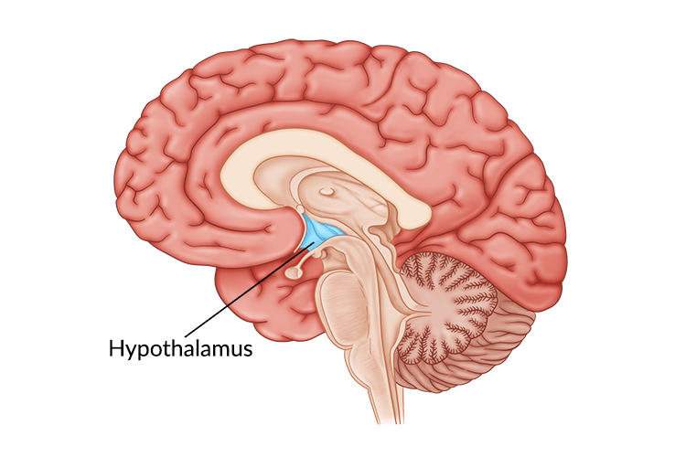 hypothalamus-damage-1